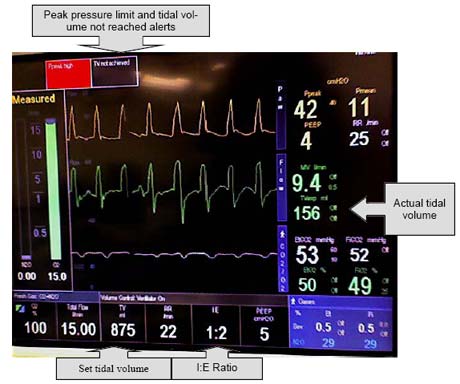 demonstration case - hyper-capno